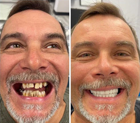 SmileShade - Instantly Hide Dental Flaws for a Perfect Smile