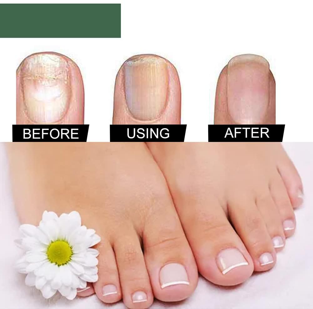 PureNail™ - Repair Serum for Damaged & Fungus-Prone Nails