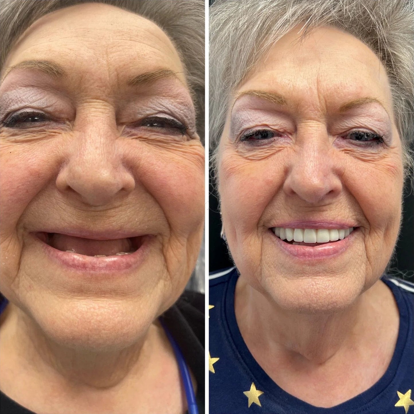 SmileShade - Instantly Hide Dental Flaws for a Perfect Smile