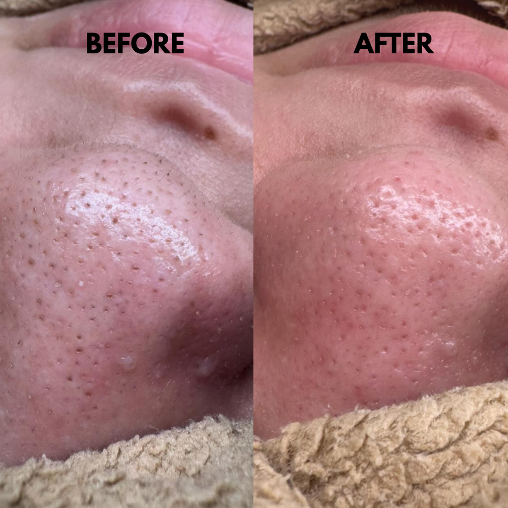 SkinSonic™ - Ultrasound Skin Scrubber for Deep Cleansing & Glow