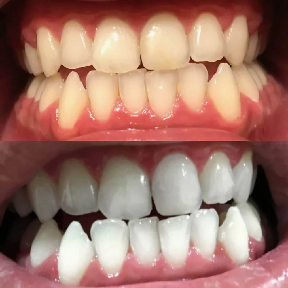 WhiteBoost™ - Teeth Whitening Pen for a Radiant Smile