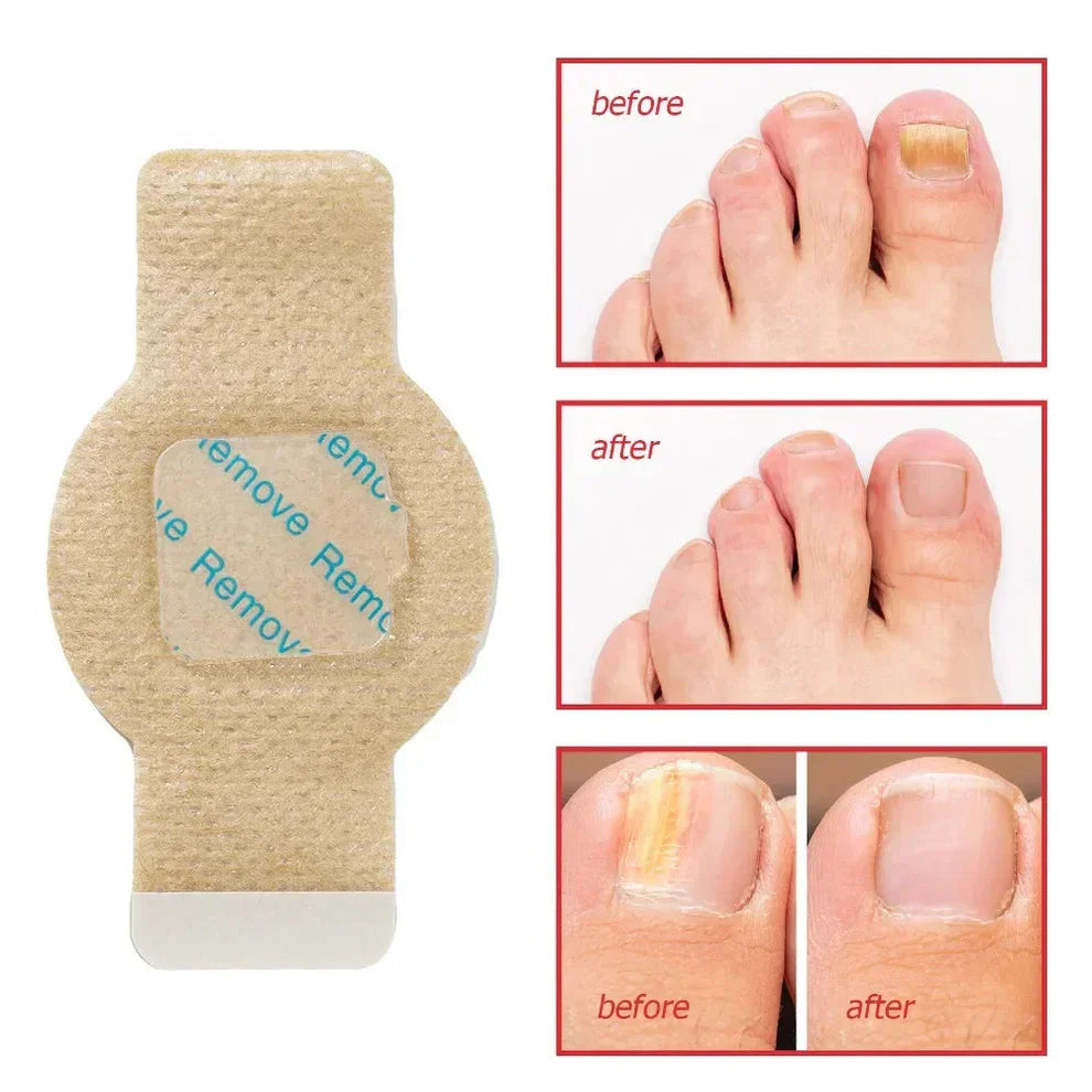 FungiCare™ - Easy-Apply Nail Repair Patches