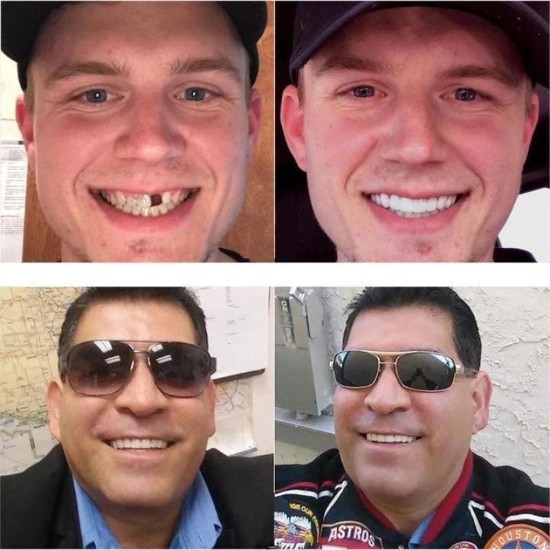 SourirePlus™ - Instant Smile Enhancer Kit