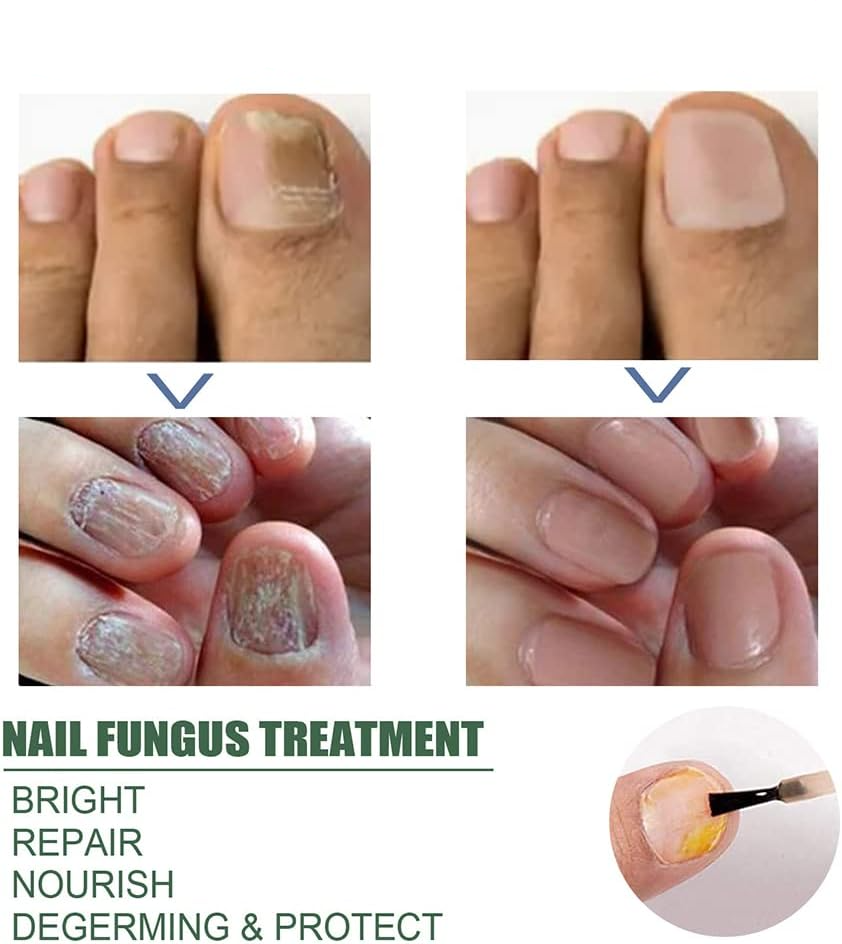 PureNail™ - Repair Serum for Damaged & Fungus-Prone Nails
