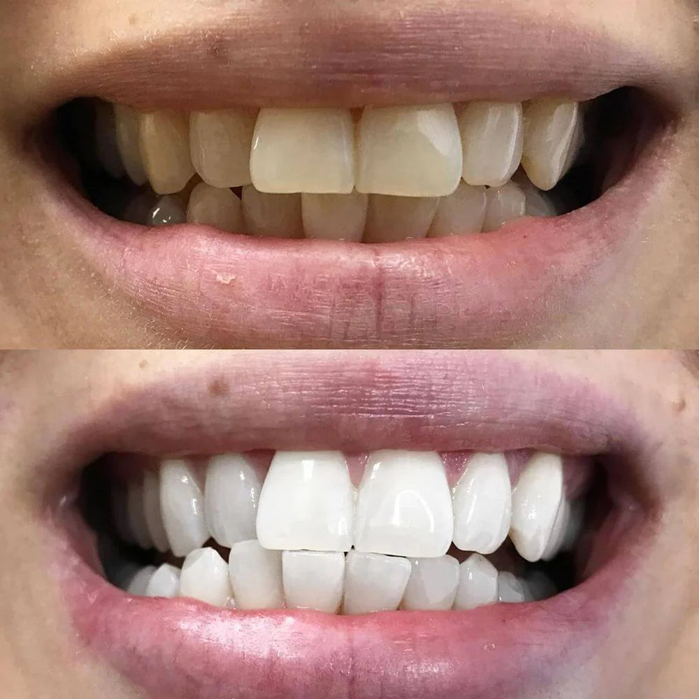 WhiteBoost™ - Teeth Whitening Pen for a Radiant Smile