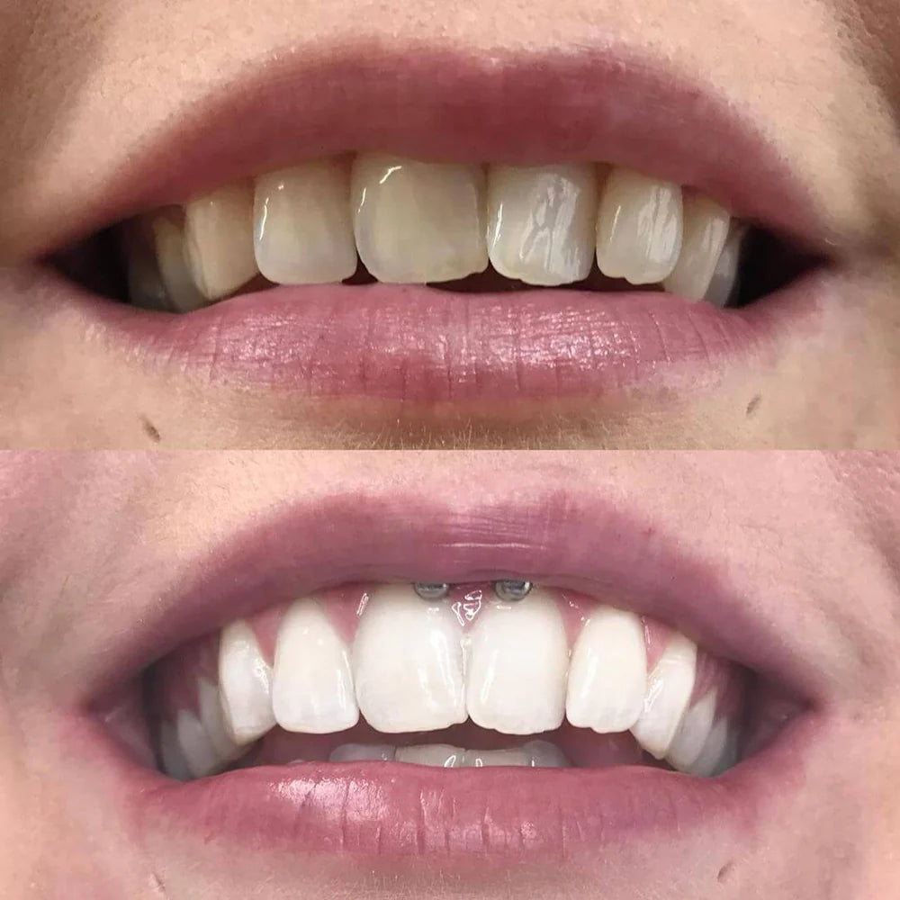 WhiteBoost™ - Teeth Whitening Pen for a Radiant Smile